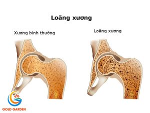 Loãng Xương