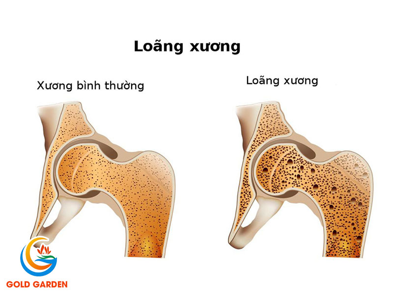 Loãng Xương